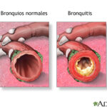 ¿Cómo es la tos de la bronquitis?