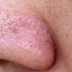 ¿Cómo limpiar los poros de la nariz?